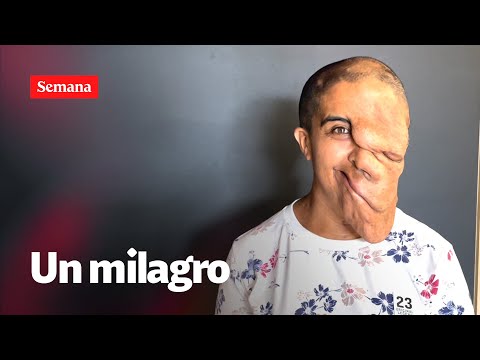 La transformación de Sandra Milena, la mujer que lleva tres décadas con tumores en el rostro